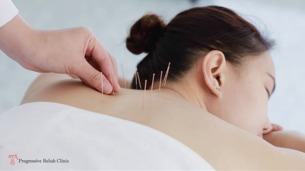 Acupuncture