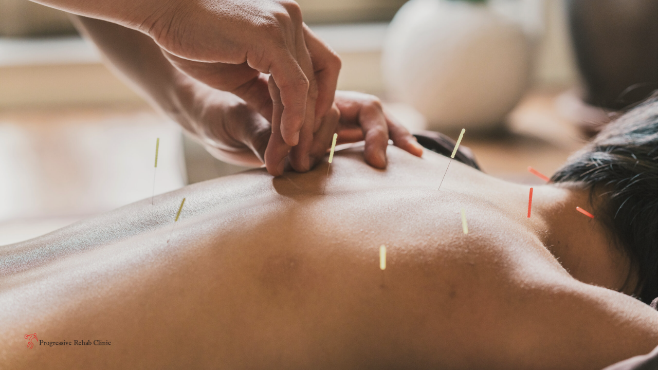 Acupuncture